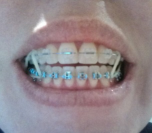 Braces with Rubber Bands: Purpose and How Long They Stay On