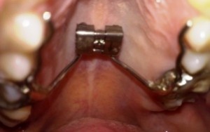 Mom Gets Braces: Palate Expander (2)