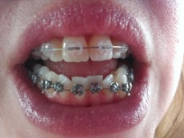 Swallowing Braces Brackets