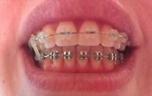 Mom Gets Braces: More Rubber Bands (8)