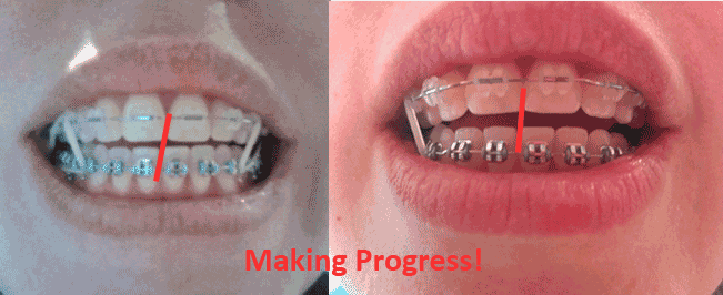 Braces with Elastics