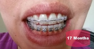 Mom Gets Braces: Know When to Hold ‘Em (9)