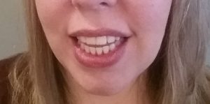 Mom Gets Braces: All Done! What Now? (10)